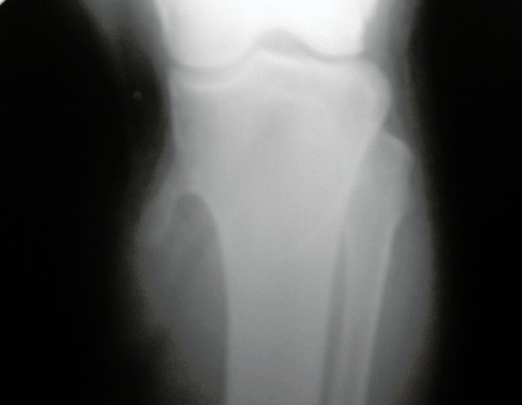 Figura 68: A radiografia exibe a lesão da osteocondromatose na perna.