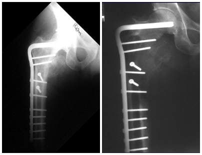 Fig. 3 e 4 – Radiografias após 2 e 3 meses respectivamente.