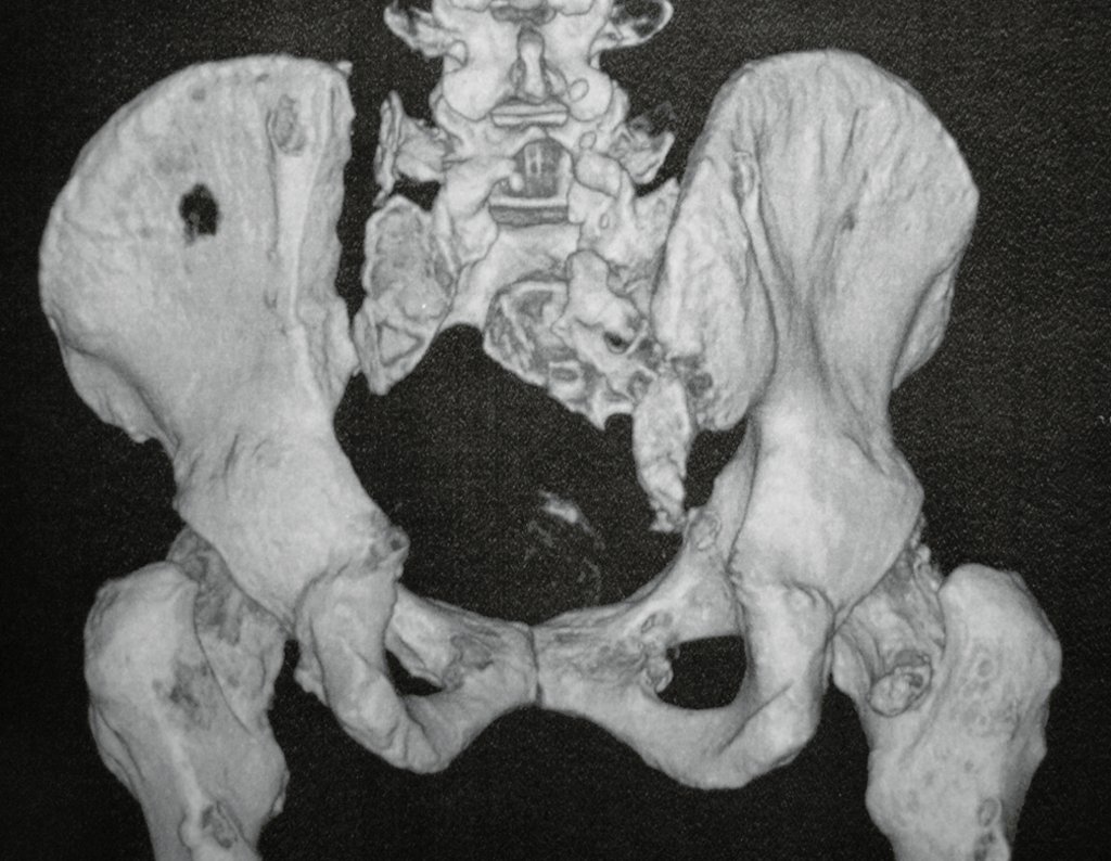 Figura 43: TC cor em 3D, pós-operatório de 2 meses evidenciando a ressecção da lesão.