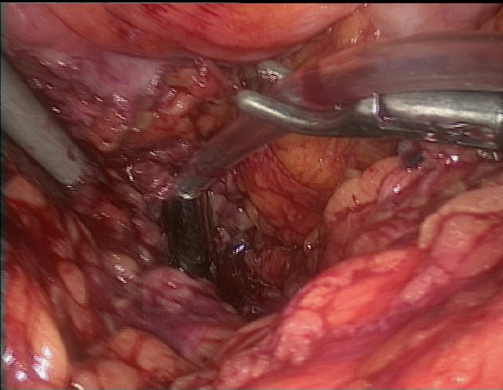 Figura 111: descrição da cirurgia vídeo Laparoscópica.