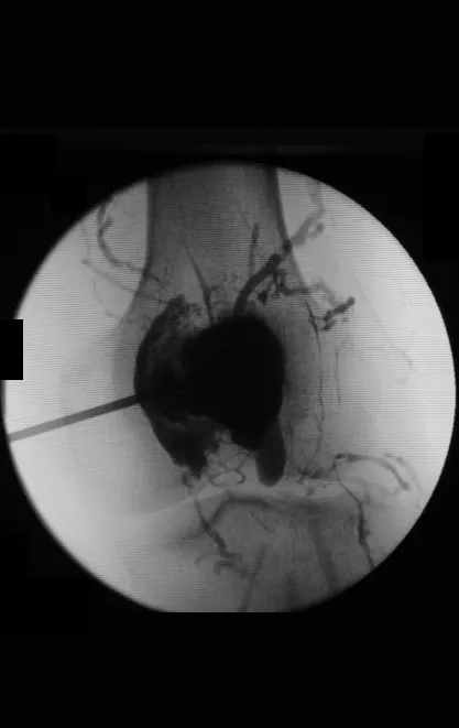 Figura 86 – contraste demonstra a alteração vascular, com verdadeiras fístulas arterio- venosas na fisiopatologia.