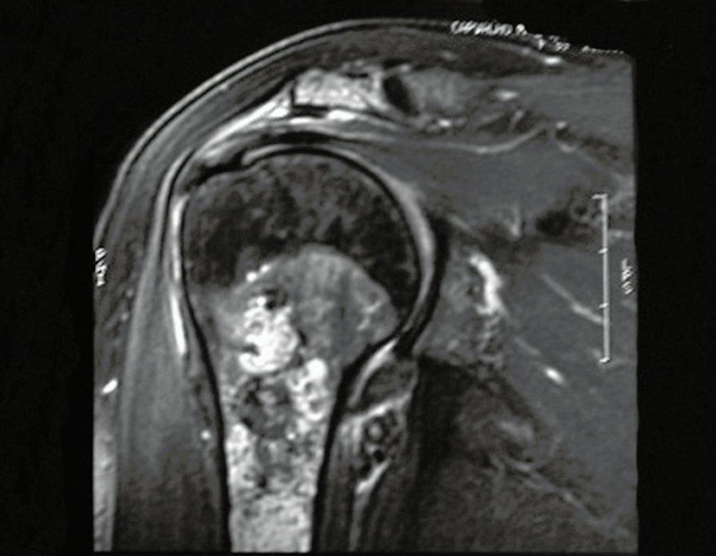 Figura 12: Ressonância magnética com focos de calcificação.