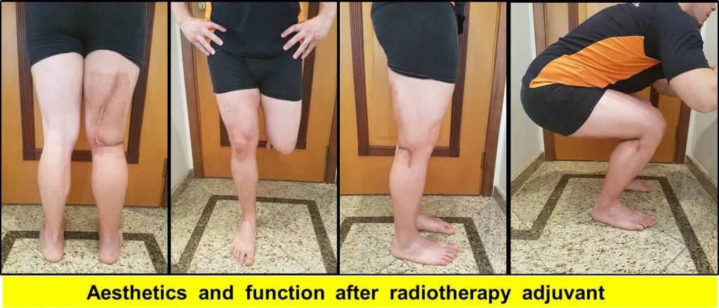 Figura 11: Função normal, após a cirurgia oncológica, possível neste paciente e radioterapia pós-operatória (adjuvante).