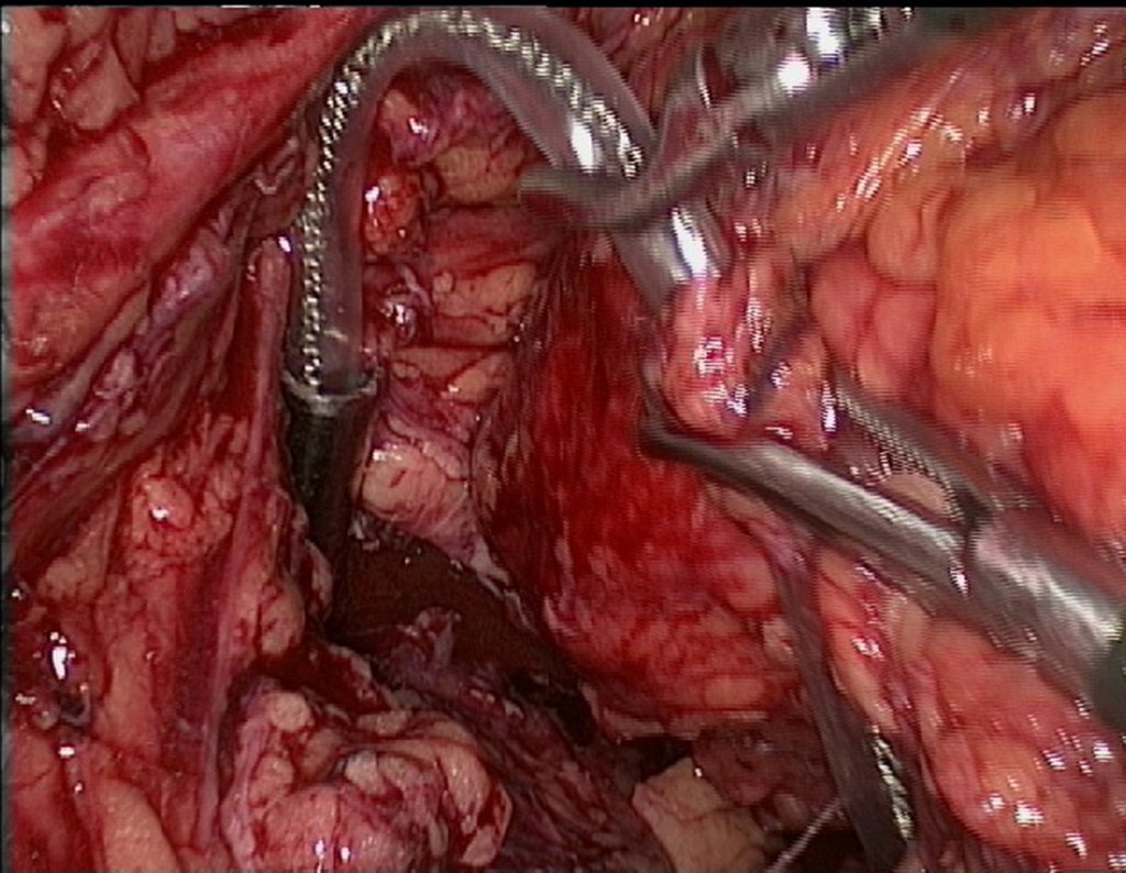 Figura 110: descrição da cirurgia vídeo Laparoscópica.