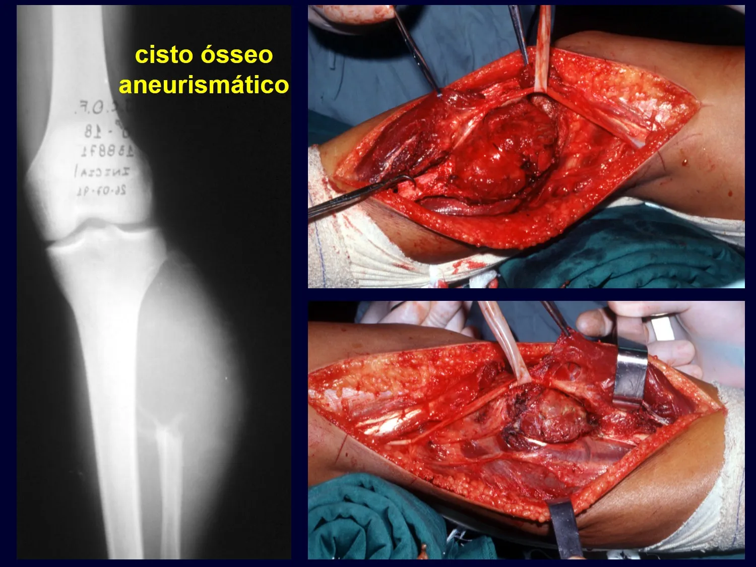 Cisto aneurismático da fíbula; lesão sendo ressecada e leito operatório após a retirada da lesão.