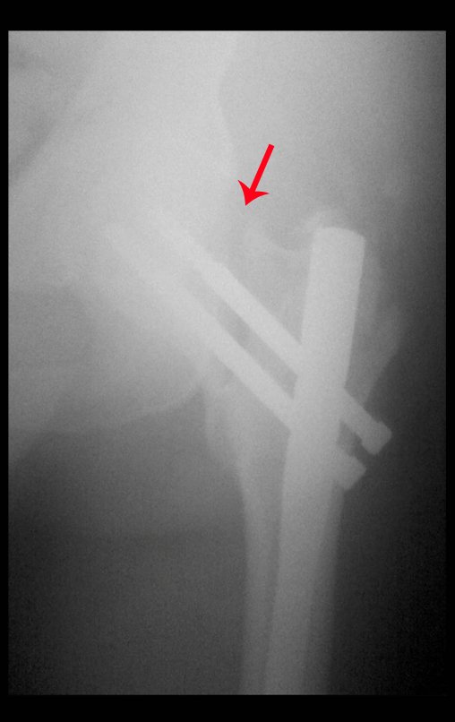 Figura 7: Fixação com haste céfalo-femoral. Em detalhe a diastase do colo.