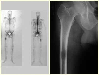 Figura 24: Cintilografia detectando apenas uma lesão. Figura 25: Pequena lesão diafisária de metástase de câncer renal.