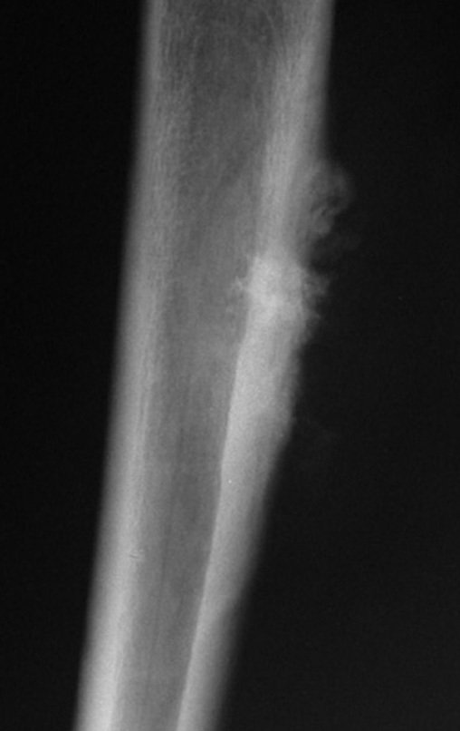 Figura 52: Radiografia da coxa direita, com lesão justacortical na face medial da diáfise femoral.