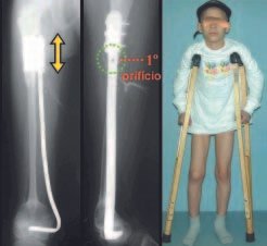 Fig. 5 – L.C.C.A., masculino, 9 anos. Dispositivo estabilizando a osteossíntese. Início do deslizamento da placa (aparece o primeiro orifício).