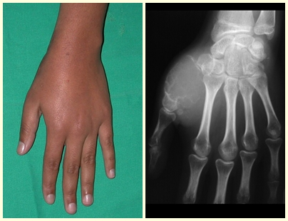 Figura 1 – aspecto clínico de osteoblastoma do primeiro metacarpeano. Fig. 2 – lesão insuflativa, com erosão da cortical e microfraturas.