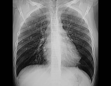 Figura 12 – radiografia do tórax, com múltiplos nódulos.