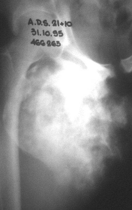 Figura 4: Grande condrossarcoma implantado no ramo íliopúbico