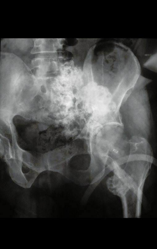 Figura 5: Radiografia da hemipelve esquerda e região sacral, afetada pelo condrossarcoma.