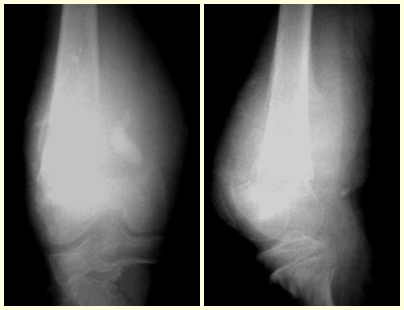 Figura 22 – osteossarcoma da metáfise distal do fêmur. Fig. 23 – fratura e disseminação local ao diagnóstico.