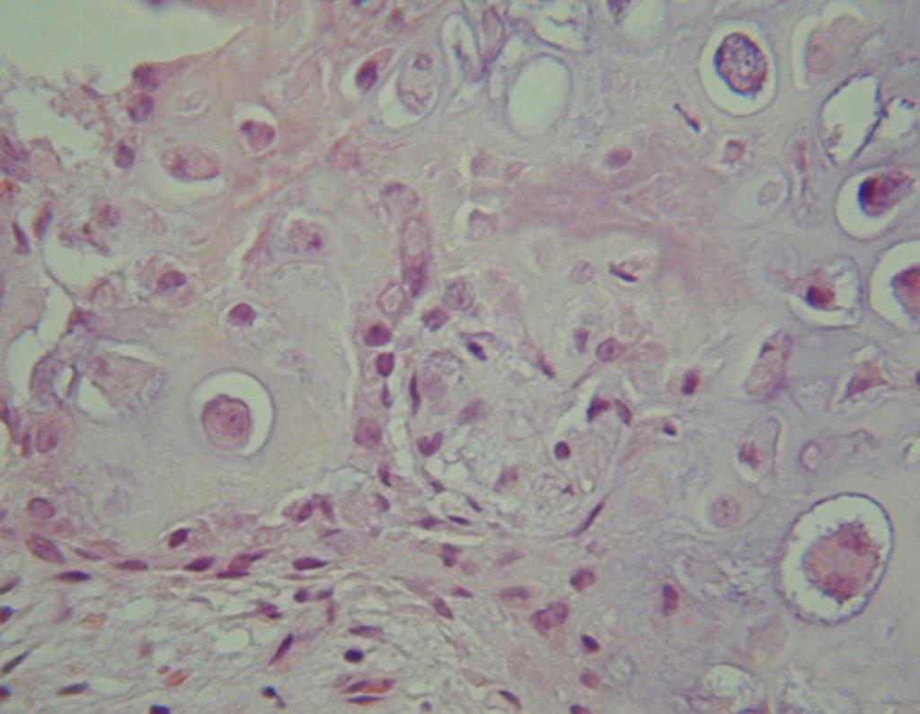 Figura 33: Condrossarcoma grau II, maior número de mitoses e desordem.