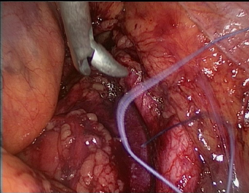 Figura 70: Aqui o Ginecologista realiza um importante passo do procedimento. Ele disceca os vasos anteriores ao tumor ligando e cauterizando com facilidade.