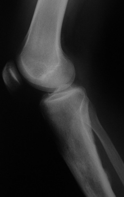 Figura 101: Radiografia pós operatória em perfil, com bom aspecto, sem sinais de recorrência.