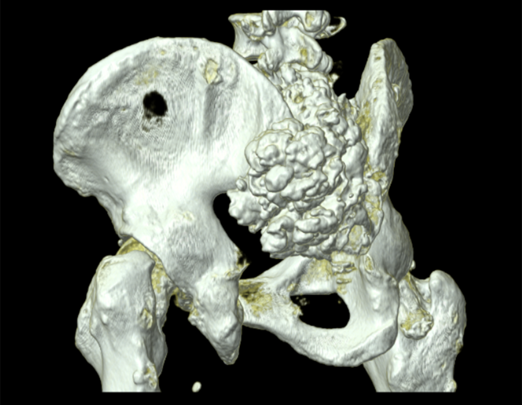 Figura 33: TC em 3D da bacia em rotação, evidenciando a lesão na região postero-lateral esquerda.