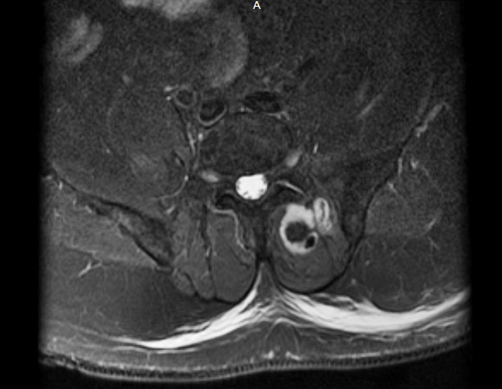 Figura 24: Rm axial T2, lesão na região da musculatura para vertebral.