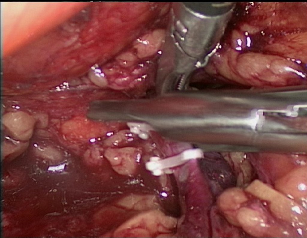 Figura 76: descrição da cirurgia vídeo Laparoscópica.