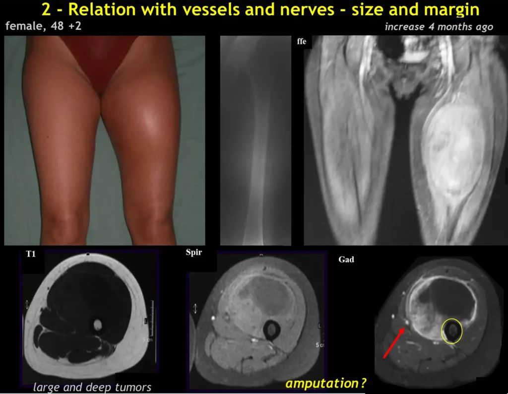 Figura 2: Neoplasia sólida, de grande volume, profunda, heterogênea, intensa captação de contraste, intimamente relacionada aos feixes vasculares e nervosos e ainda em contato com mais da metade circunferencial do fêmur?