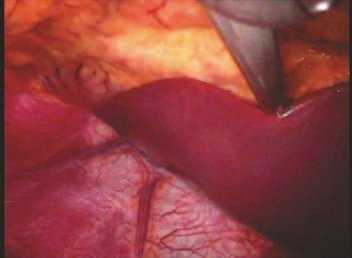 Figure 2 – Videolaparoscopic view of the mirrored anatomy of the abdominal organs.