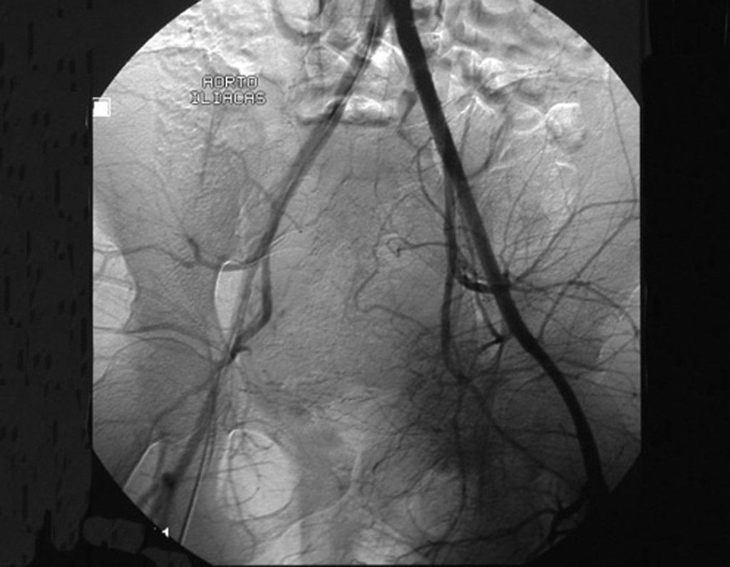 Figura 76: A arteriografia revela hipervascularização.