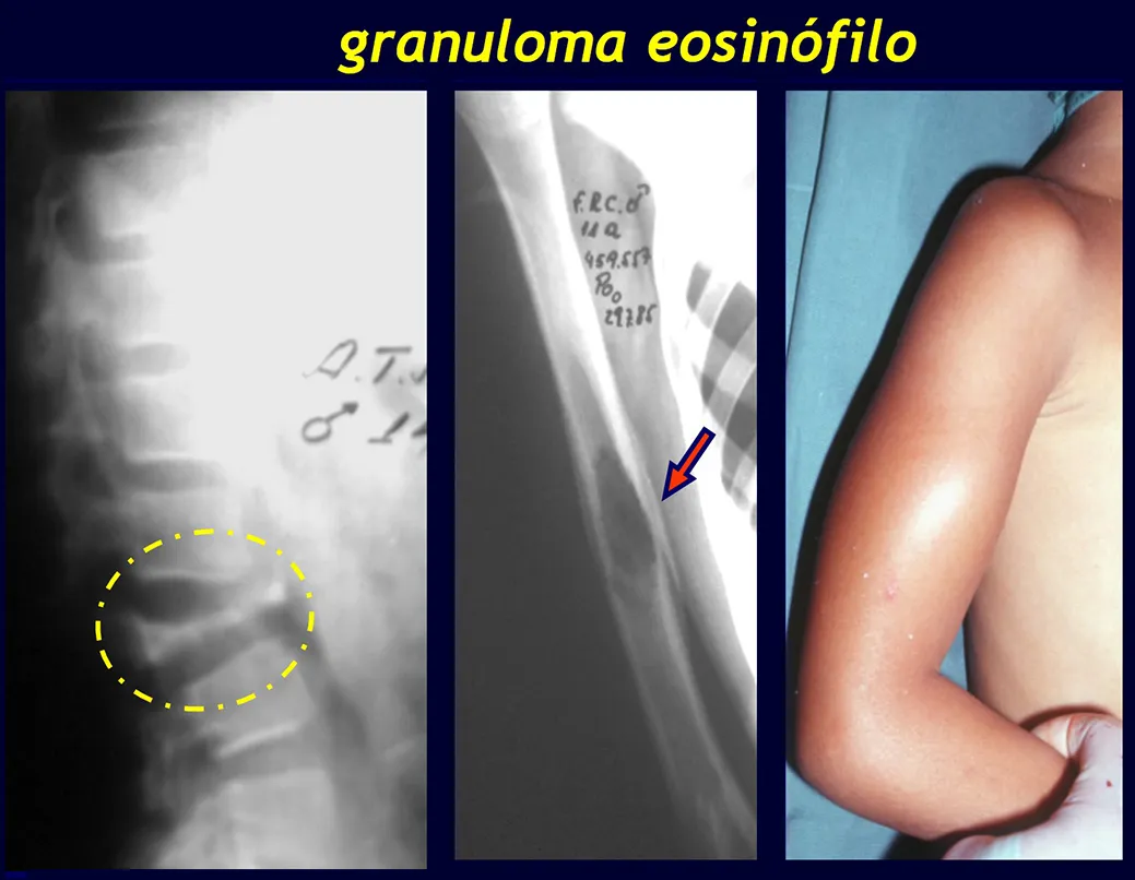 Vértebra plana de Calvé – Granuloma eosinófilo do úmero – Aspecto clínico do braço