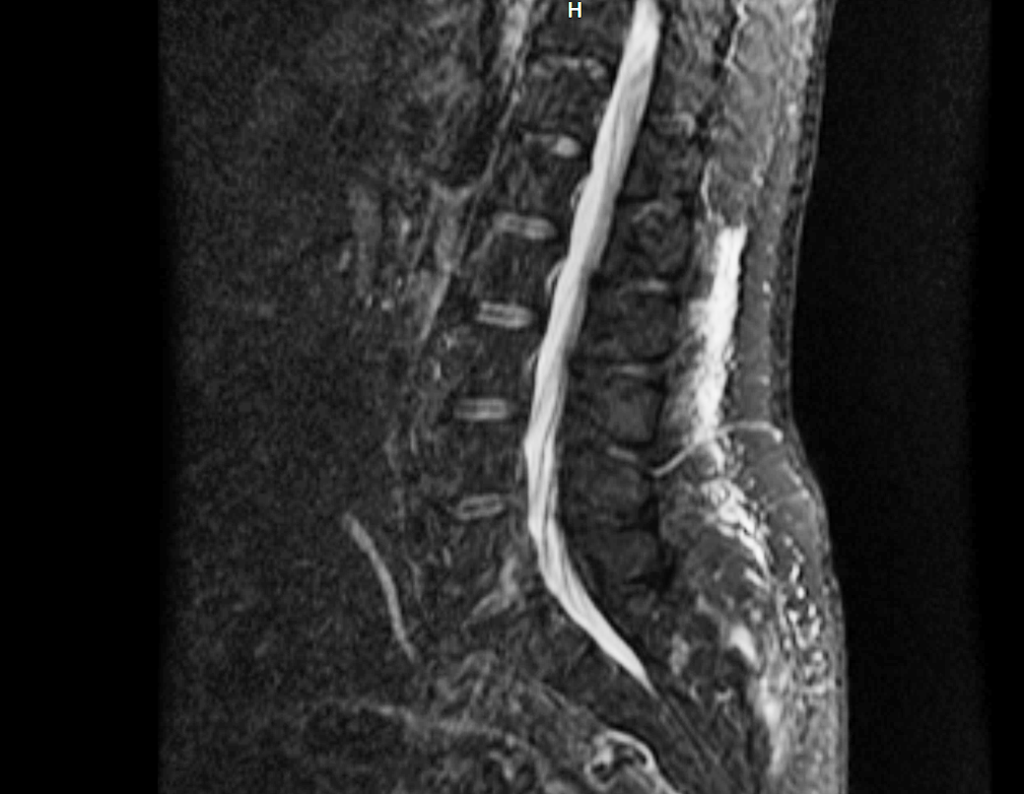 Figura 22: Rm sag T2 stir, mostrando a lesão heterogênia acomentendo região mais posterior do sacro.