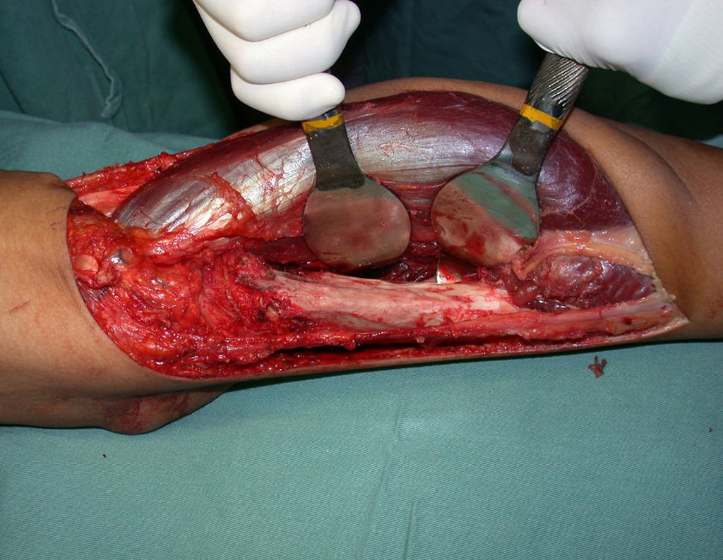 Figura 98: Aspecto após a ressecção parietal do tumor, removendo uma faixa de tecido ósseo sadio na profundidade da lesão. Observe o aspecto macroscópico normal do leito cirúrgico.