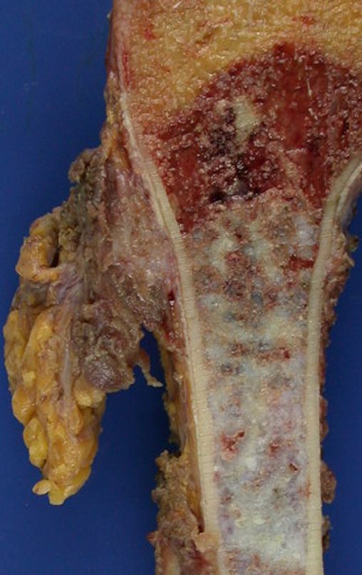 Figura 15: As células cartilaginosas nutrem-se por embebição, implantando-se com facilidade. Em detalhe a disseminação iatrogênica do tumor.