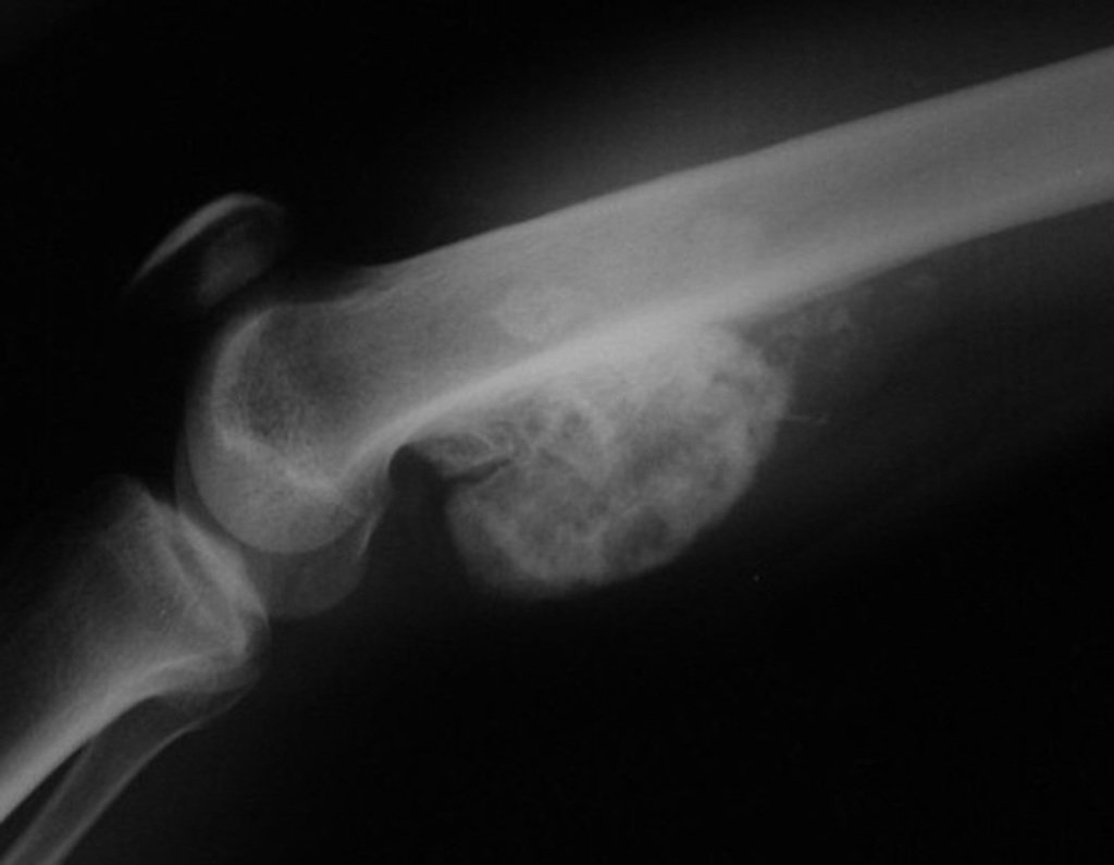 Figura 57: Condrossarcoma justacortical da extremidade distal do fêmur.