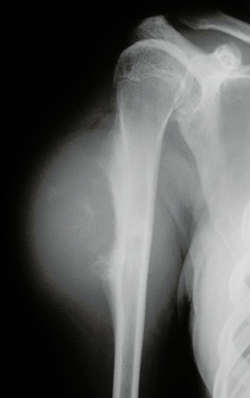 Figura 16: Radiografia de condrossarcoma justacortical, com grande tumor provocando impressão na cortical lateral do úmero.