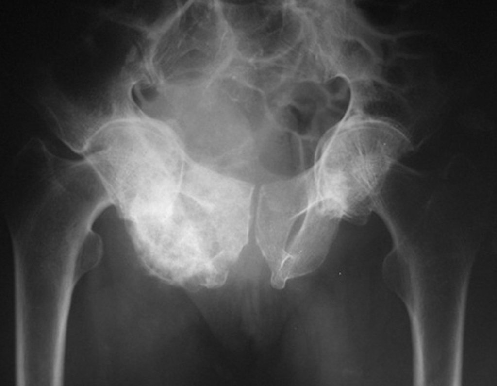 Figura 38: Radiografia de condrossarcoma primário no anel obturador da pelve direita.