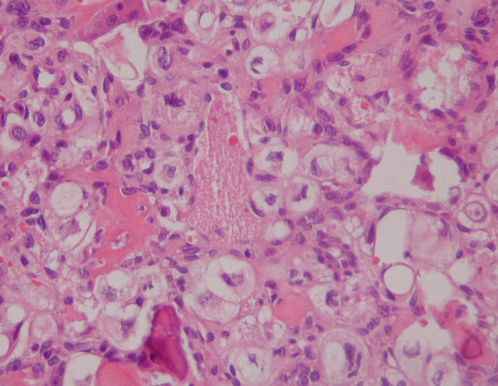 Figura 105: Histologia de condrossarcoma de células claras. Células redondas, com citoplasma claro e células gigantes.