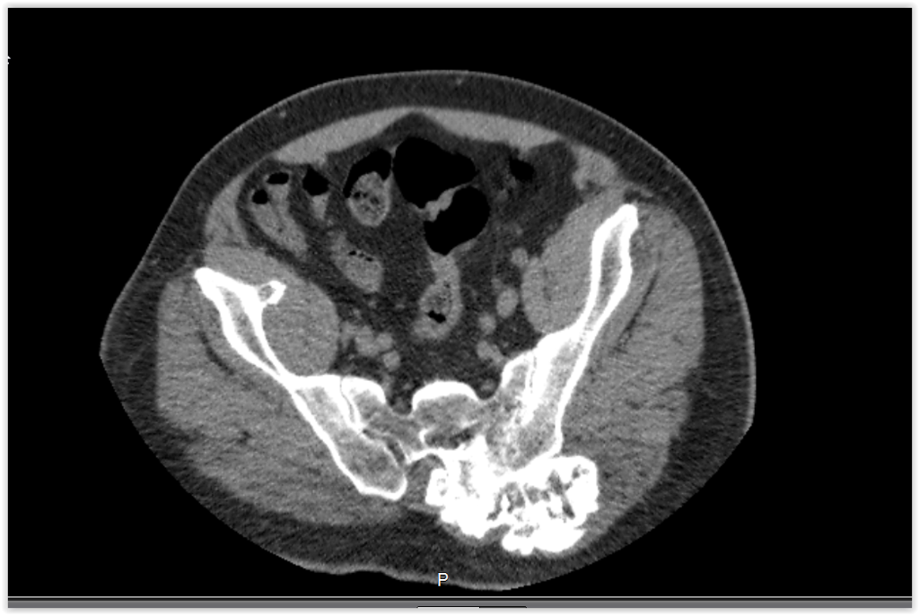 Figura 9: Tomografia com lesão crescendo por sobre a asa do ilíaco esquerdo.