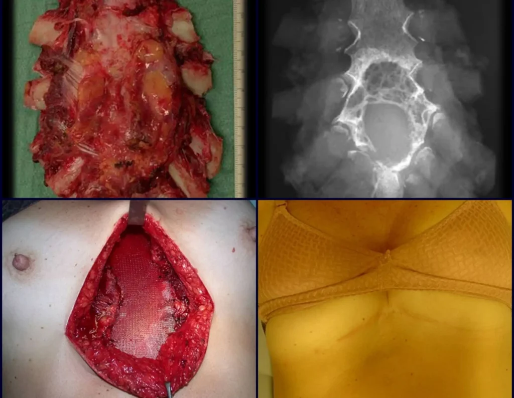 Figura 18: a- Visualização da peça ressecada. b- Radiografia da peça evidenciando a lesão. c- Reconstrução da cavidade com Tela de Marlex. d- Aspecto estético da cicatriz operatória, após 3 anos.