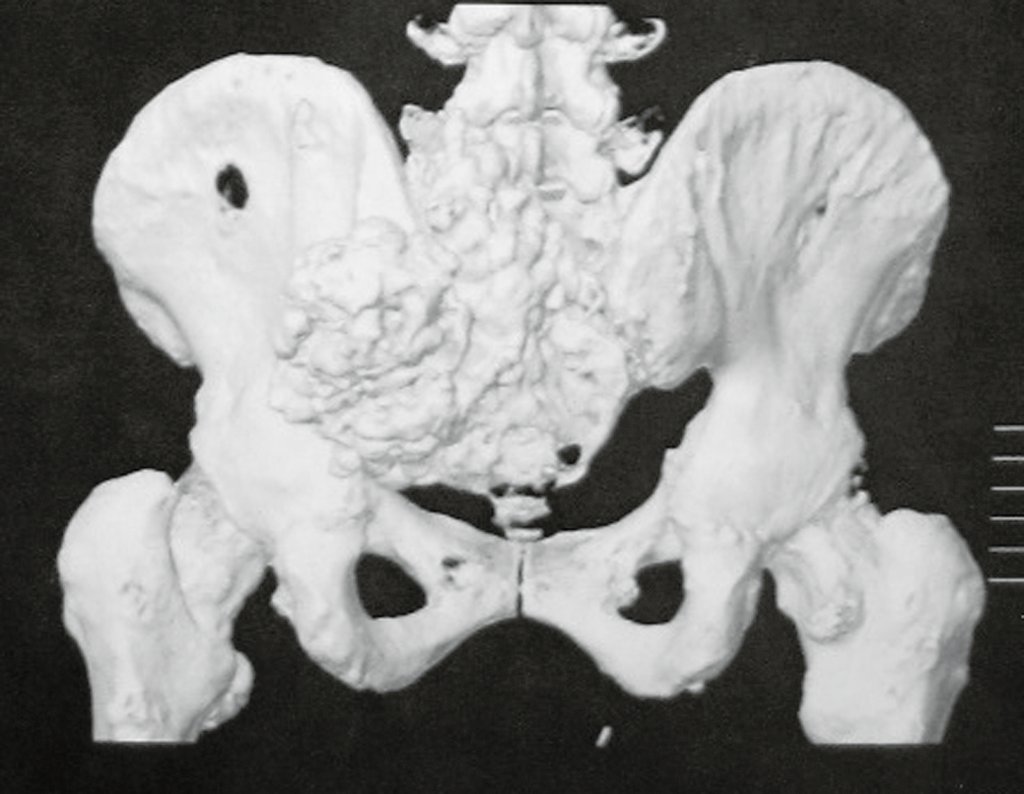 Figura 36: TC em 3D da bacia vista posterior.