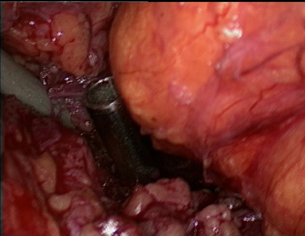 Figura 106: descrição da cirurgia vídeo Laparoscópica.