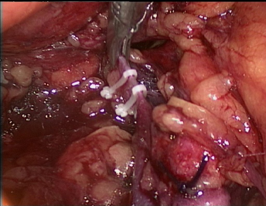 Figura 77: descrição da cirurgia vídeo Laparoscópica.