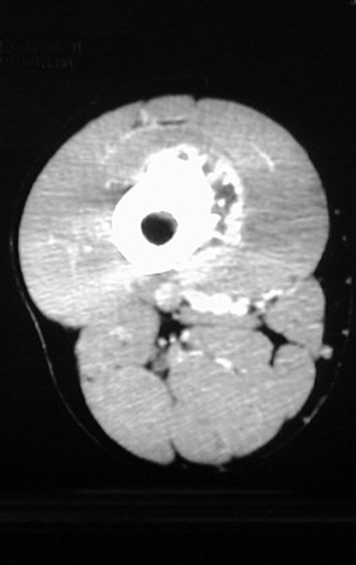 Figura 55: Tomografia com densidade para osso, com tumor extracortical envolvendo a superfície do fêmur, na face lateral, anterior e medial.