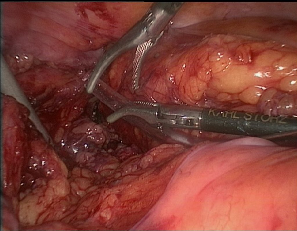 Figura 107: descrição da cirurgia vídeo Laparoscópica.