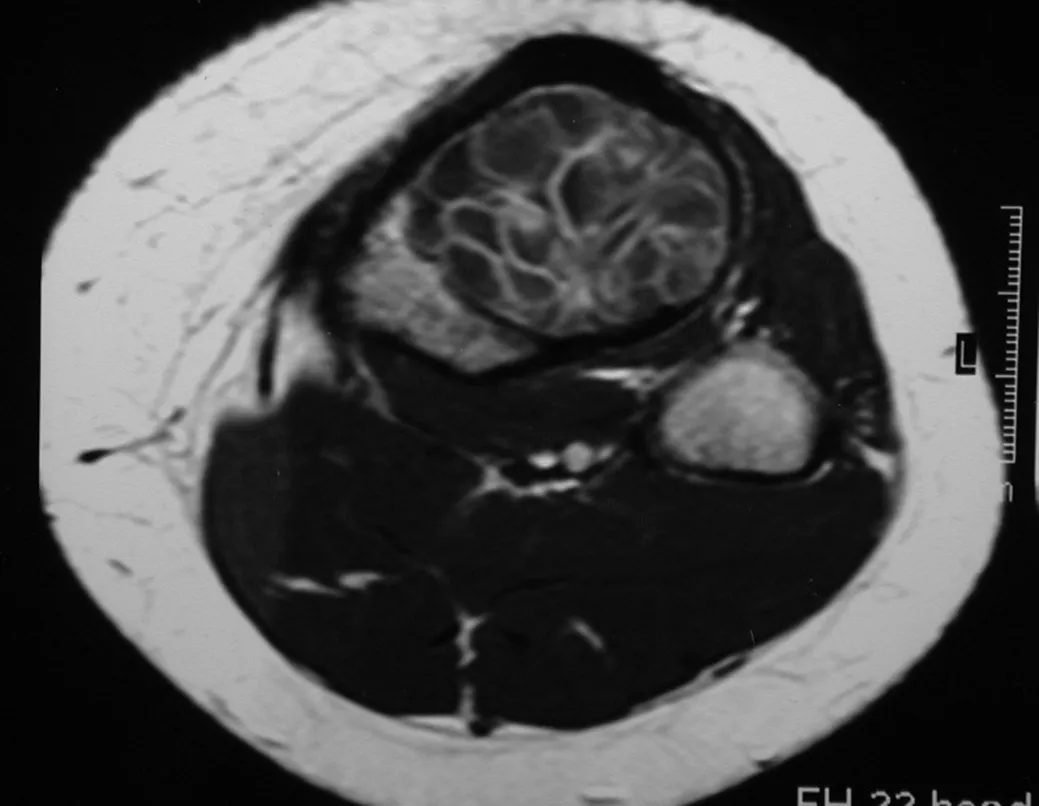 Figura Figura 55 – Cisto ósseo aneurismático da tíbia. As lojas ocorrem em número e tamanho variados, aglomerando-se e provocando erosão do trabeculado ósseo, que se expandem e insuflam a cortical.