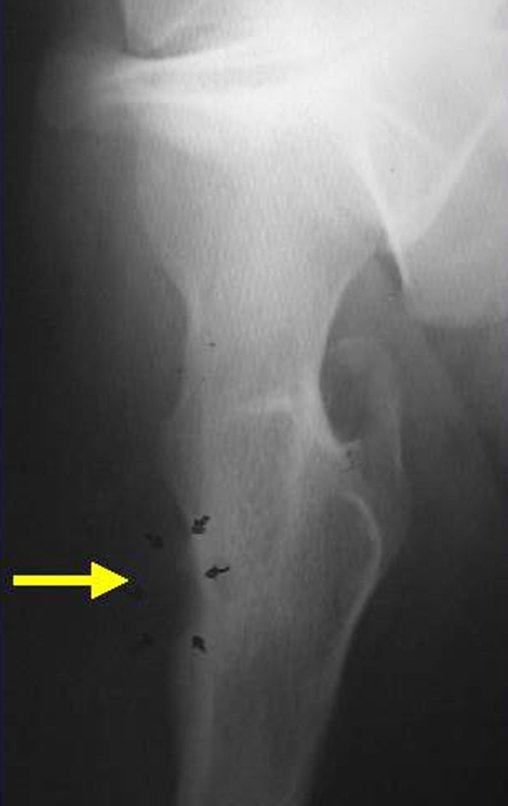 Figura 5: Osteoma osteóide subperiosteal na face medial do fêmur.