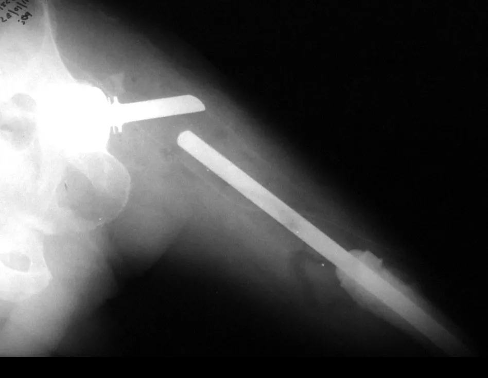 Fig. 6 – Realizada ressecção tumoral e colocação de endoprótese não convencional de Fabroni com quadril articulado. Radiografia em projeção ântero-posterior.