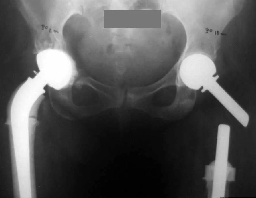 Figura 21: Operada antes de fraturar. Reconstrução bilateral com endoprótese.