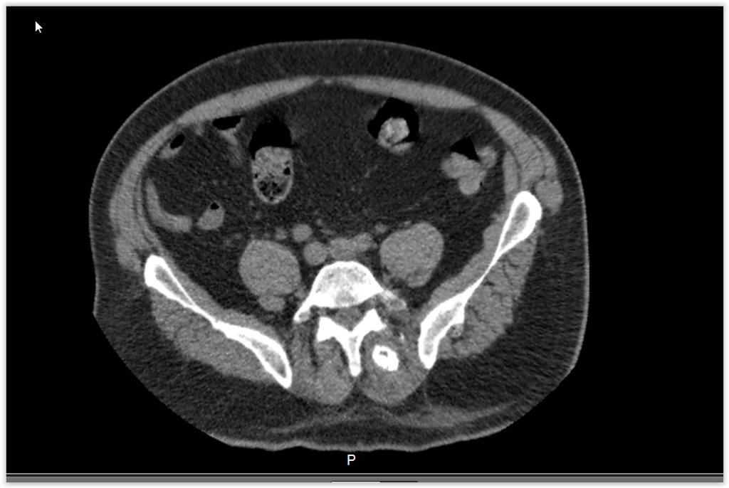 Figura 6: Tomografia axial evidenciando o limite proximal da lesão infiltrando a musculatura para vertebral esquerda com calcificação próxima a face externa da lâmina.