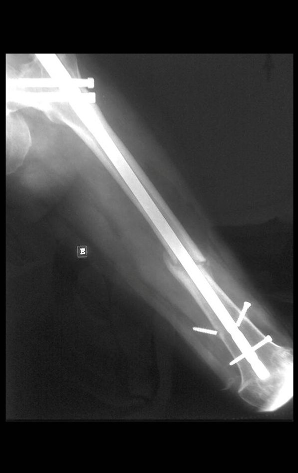 Figura 11: Pseudo-artrose da diáfise femoral e quebra do parafuso de bloqueio, o que era previsível.