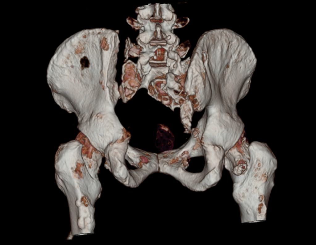 Figura 165: TC cor em 3D, vista posterior.