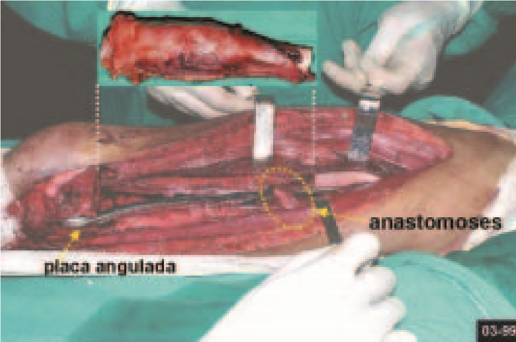 Fig. 2 – Acesso medial, facilitando as anastomoses. Detalhes da peça ressecada, da placa angulada e das anastomoses.